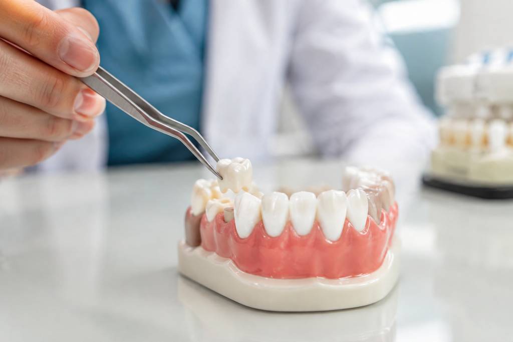 Dents zircone : avantages, prix et durée de vie des couronnes dentaires